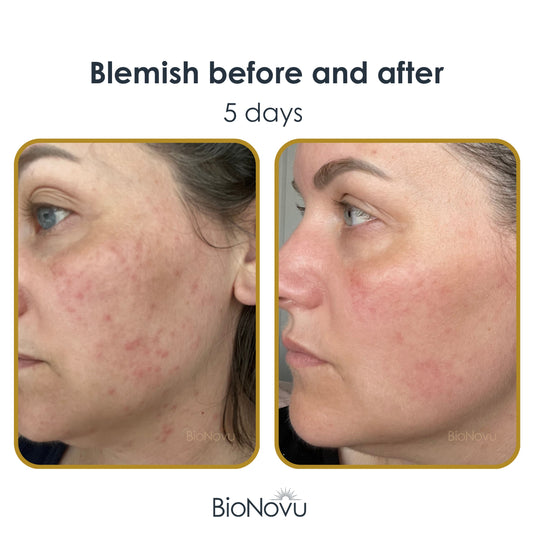 How LED Masks Can Help Blemish-Prone Skin