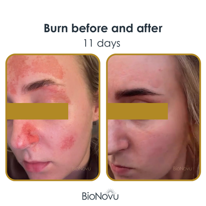 NovuMask Red Light Therapy Mask | BioNovu