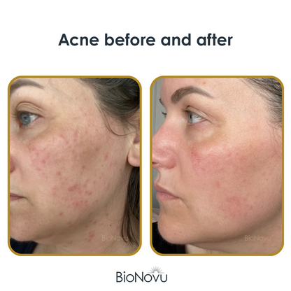 NovuMask Red Light Therapy Mask | BioNovu